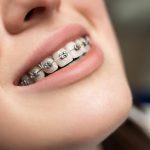کامپوزیت دندان در مشهد